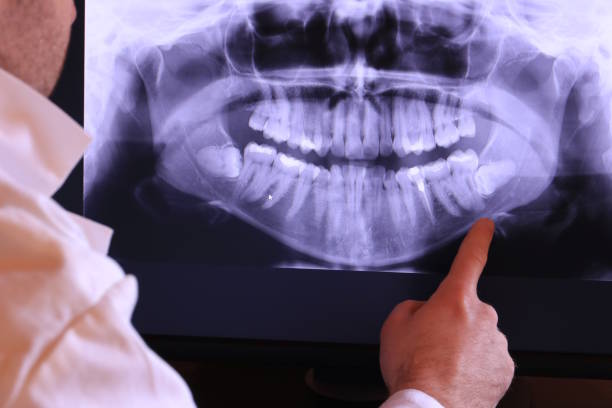 Best Knocked-Out Tooth (Avulsed Tooth) Treatment in White Haven, PA