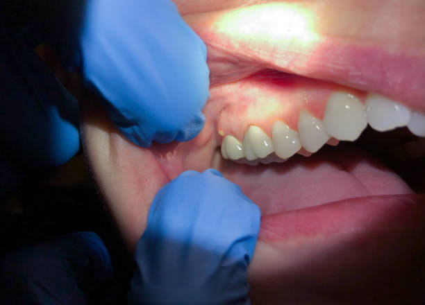 Best Walk-In Emergency Dental Services in White Haven, PA